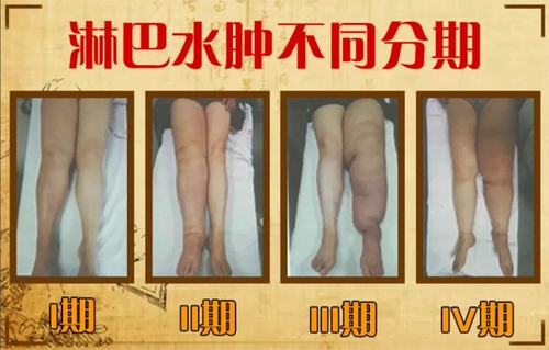 问：“下肢水肿像水桶！走不了路！该怎么办？”