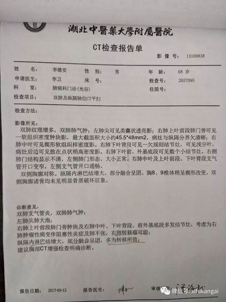 小细胞肺癌家属:袁院长是最可靠的!