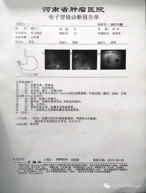 同时身患乳腺癌与胃癌面对西医束手无策单吃十个月中药病情好转