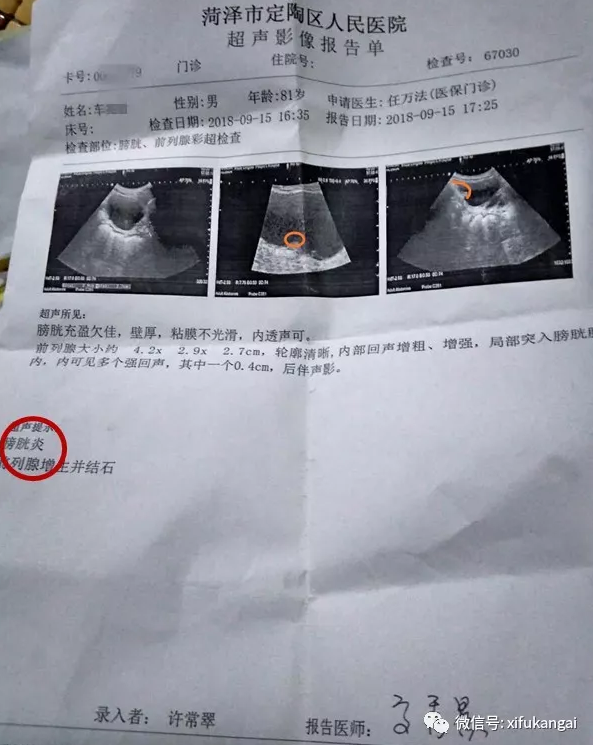 81岁高龄膀胱癌患者肿瘤消失的秘密