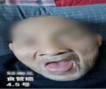 病历研讨 | 从进食困难到正常吃喝，食管癌患者三个月的变化